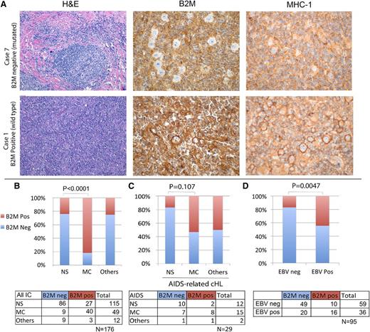 Figure 5. B2M validation by immunohistochemistry and correlation with subtype and EBV status. (A) Hematoxylin and eosin (H&E) staining and immunohistochemical staining for B2M and for MHC-I are shown for 2 representative cases of cHL. Case 1 has wild-type B2M sequences, whereas case 7 is mutated for B2M, indicating that this genomic alteration can be determined by lack of B2M expression in HRS cells. Correspondingly, case 1 shows clear Golgi and membrane localization of MHC-I, whereas staining is diffuse in the cytoplasm in case 7, indicating mislocalization. Original magnifications ×20 (H&E) and ×60 (B2M and MHC-I). (B) There was a significant correlation between the lack of B2M expression and the NS subtype of cHL, and between the presence of B2M expression and the MC subtype of cHL. Cases classified as “Others” include 1 case of lymphocyte-rich cHL and cases with features of both NS and MC, making the distinction challenging. (C) A cohort of patients with HIV infection and cHL was evaluated for B2M expression; however, the relationship of histologic subtype and B2M expression did not reach statistical significance in this cohort. (D) The presence of EBV in the HRS cells was assessed by in situ hybridization for Epstein-Barr encoding region. EBV-negative cases were more frequently also negative for B2M; however, among the EBV-positive cases, both B2M-positive and B2M-negative cases were identified. IC, immunocompetent; neg, negative; pos, positive.