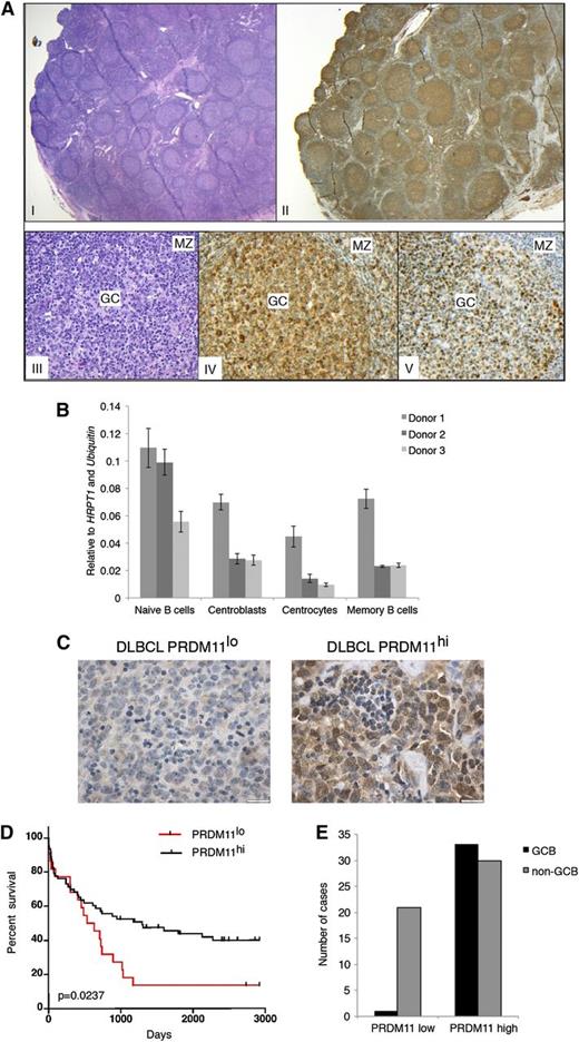 Figure 3. PRDM11 deficiency correlates with poorer survival in human DLBCL patients. (A) Human lymph node with follicular hyperplasia (I: hematoxylin and eosin (H&E); ×12.5) showing preferential labeling of PRDM11 in the germinal centers (II: PRDM11; ×12.5). The germinal center reaction is shown at a higher magnification (×200) in III; IV: H&E; V: PRDM11 staining of BCL6 illustrating that PRDM11 labels the GC (IV) similar to BCL6 (V), but also stains scattered small lymphocytes in the mantle zone (MZ). (B) Expression level of PRDM11 in sorted B-cell populations from 3 human tonsils measured by qRT-PCR. (C) Representative α-PRDM11 immunostainings from human DLBCLs with either low PRDM11 (left; scale bar = 20 µm) or high PRDM11 (right; scale bar = 20 µm). (D) Kaplan-Meier survival curves comparing the survival of DLBCL patients according to PRDM11 levels. Patients with low levels of PRDM11 have significantly poorer survival (P = .0237, log-rank test). (E) Number of PRDM11lo or PRDM11hi DLBCLs according to GCB and non-GCB subtypes.