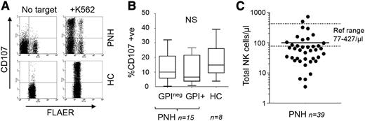 Figure 1. NK cell activity in PNH. (A) NK cell granule exocytosis in PNH. NK cells were purified from blood samples from healthy controls (HCs) or PNH patients using indirect selection reagents from Miltenyi. NK cell degranulation was assayed using a modification of a standard method to allow detection of GPI+ and GPI-deficient NK cells using fluorescent aerolysin (FLAER) (supplemental Text).8 Briefly, purified NK cells were cocultured with K562 target cells (for 4 hours). Cocultures were then stained with anti-CD56 antibody to identify NK cells, FLAER to distinguish GPI-deficient and GPI+ cells, and anti-CD107 to identify degranulated NK cells. This analysis is from 1 PNH patient and 1 HC (gating on the purified CD56+ NK cells) with the data from the cohort shown in panel B. We also compared the mean fluorescence intensity of CD107 staining in paired GPI-deficient and GPI+ cells within each patient. This demonstrated a significant increase in CD107 display on the GPI-deficient NK cells (supplemental Figure 1). (B) Summary of NK cell degranulation activity from 15 PNH patients and 8 HCs. The box plot shows the percentage of GPI-deficient (GPIneg) and GPI+ NK cells that have degranulated in response to target cells. The range (whiskers), median (horizontal line), and interquartile range (box) are shown. The percentage of CD107+ NK cells was not statistically significant (NS) between any 2 groups according to the Mann-Whitney test. Comparison of the percentage of CD107+ NK cells within individual patients showed no significant differences between matched GPI+ and GPIneg NK cells (supplemental Figure 1). (C) Number of total NK cells in 39 PNH patients (cells per microliter). Patient values ranged from 3 to 725 cells per microliter (mean, 100 cells/μL). A European reference range (77-427 cells/μL) is shown by the dotted lines. The patients with NK cell counts within the normal range were unremarkable in terms of gender, age, or treatment (cyclosporin or eculizumab). Furthermore, there was no correlation between the NK cell counts and the absolute numbers of other cell types (supplemental Figure 2). Peripheral blood samples used in this work were collected after informed consent in accordance with the Declaration of Helsinki.