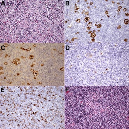Figure 1. Histopathology and immunohistochemistry of HIV-cHL. (A) Hematoxylin and eosin staining shows cHL, MC subtype. Immunostaining for (B) CD15, (C) CD30, and (D) EBV latent membrane protein 1 demonstrates Hodgkin Reed-Sternberg cells. (E) CD68 staining showing many (>5%)46 macrophages. (F) Hematoxylin and eosin staining at time of relapse shows cHL, MC subtype. Original magnification ×40.