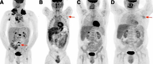 Figure 2. 18FDG-PET in HIV-cHL. (A) Baseline 18FDG-PET. Volumetric image shows bulky intensely hypermetabolic cervical, mediastinal, and axillary lymph nodes and multiple focal bone lesions (representative vertebral lesion, red arrow). (B) Interim 18FDG-PET. At the end of cycle 2, coronal image focuses on a small suspicious lesion in left axilla (red arrow); diffuse bone uptake attributable to pegfilgrastim is also noted. After cycle 6, a biopsy sample of residual abnormalities in the left axilla showed reactive changes and no evidence of cHL. (C) End-of-therapy 18FDG-PET. Volumetric image shows resolution of 18FDG avid nodes. (D) Relapse 18FDG-PET. Volumetric image shows left axillary avid lymph node (red arrow) and other small nodes above the diaphragm.
