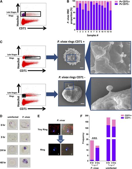 Figure 2. P vivax infection induces a rapid remodeling of the cell surface and the cytoplasmic compartments of immature reticulocytes. (A) Flow cytometry of P vivax field isolates stained with Hoechst and for CD71 using a gating strategy to identity CD71+ (pink) and CD71− (purple) P vivax–infected cells. (B) Proportion of CD71− (pink bars) and CD71+ (purple bars) P vivax (Pv)-infected cells from 13 clinical samples. The mean percentage of uninfected CD71+ cells is 1.29% ± 1.31% SD. (C) Gating strategy for CD71+ and CD71− P vivax rings flow cytometry sorting; the lower Hoechst signal is associated with ring-stage parasites. The insert on the right shows the SEM scans of the 2 populations (scale bars represent 1 μm) and the blue box indicates the area shown at higher magnification (scale bars represent 100 nm). (D) The exclusion reticular material (subvitally stained with Giemsa) in uninfected and P vivax–infected CD71+ reticulocytes over a period of 40 hours. Scale bar represents 1 μm. (E) Rapid disappearance of CD71 in an ex vivo P vivax–invaded reticulocyte. These freshly invaded CD71+ reticulocytes with P vivax rings were counterstained with Alexa 546 and Hoechst to stain parasite DNA and were observed under a fluorescent microscope during the first 3 hours postinvasion. Scale bar represents 1 μm. (F) Frequency of CD71+ (pink) and CD71− (purple) uninfected or P vivax–infected reticulocytes at invasion 0 and 3 hours after reinvasion.