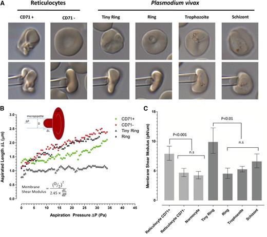 Figure 4. Evolution of cell deformability during the maturation of P vivax. (A) Representative micropipette aspiration images of CD71+ and CD71− reticulocytes and of P vivax IRBCs at the different maturation stages (based on the size of the parasitophorous vacuole and arrangement of hemozoin). (B) Key examples of single-cell measurements of cell length aspirated with different pressure intensities. Also provided is a diagram (upper left corner) and the equation (lower left corner) to show how the shear flow modulus for each cell was calculated. ΔL, aspirated length; ΔP, aspirating pressure; D, micropipette inner diameter; dL/dP, slope of the linear region of the aspiration graph as shown in this figure. (C) The median shear flow modulus (± interquartile range) of each population. Note that the uninfected CD71+ reticulocytes and tiny ring forms have the highest shear modulus (ie, the most rigid cells), which was significantly higher than any of the other normocytes and other infected red cells. n.s., not significant.