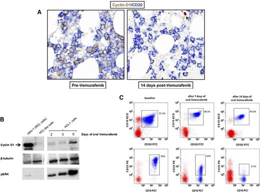 Figure 3. BRAF inhibition downregulates the expression of HCL-specific markers in vivo. (A) Immunohistochemistry shows strong cyclin D1 downregulation (brown nuclear staining) by HCL cells (defined by the blue membrane staining for CD20) in bone marrow biopsies of a trial HCL patient taken before and after 2 weeks of oral treatment with vemurafenib 960 mg twice daily. The arrow in the right panel indicates a cyclin D1+ non-B cell as internal control. (B) Western blotting for cyclin D1, phospho-ERK, and (as loading control) tubulin β in primary leukemic cells purified from the blood of a HCL patient (HCL 1) before and after 2 and 3 days of oral vemurafenib. A mantle cell lymphoma cell line (Jeko-1) and primary purified leukemic cells from a HCL-like patient were used as positive and negative control for cyclin D1 expression, respectively. (C) Flow cytometric expression of surface CD25 in blood leukemic cells (coexpressing CD19 and CD103; blue events in the CD45+ gate) of HCL patient 4 before and after treatment with oral vemurafenib for 7 and 14 days. Red events represent the rest of CD45+ blood cells.