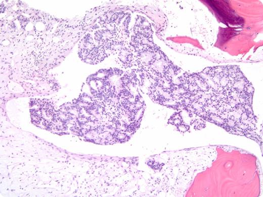 A 47-year-old African American man presented with lightheadedness and exertional dyspnea. Laboratory work revealed: hemoglobin, 2.9 g/dL; platelets, 17 × 109/L; and lactate dehydrogenase, 1492 IU/L. Folate, B12, and coagulation studies were normal. His peripheral smear showed increased schistocytes, polychromasia, and nucleated red blood cells. The patient was started on plasma exchange for presumed thrombotic thrombocytopenic purpura (TTP). However, his hematologic parameters failed to improve, and his pretreatment ADAMTS13 activity of 54% prompted further evaluation. A bone marrow biopsy demonstrated diffuse infiltration by adenocarcinoma, positive for prostate-specific antigen (PSA) and CK19 by immunohistochemistry, consistent with a diagnosis of metastatic prostate cancer. His serum PSA was elevated at 1162 ng/mL, and imaging revealed retroperitoneal lymphadenopathy with scattered bone lesions. The patient was started on combined androgen blockade with bicalutamide and leuprolide. After 8 weeks of treatment, his platelet count normalized and his hemoglobin improved to 10 g/dL. / Bone marrow involvement by metastatic carcinoma is uncommon and typically represents a late manifestation of disease. Marrow infiltration can lead to intramedullary hemolysis with significant cytopenias and schistocytes on peripheral smear, mimicking TTP. In this case, the patient’s hematologic manifestations were the presenting features of his malignancy, creating a diagnostic dilemma.