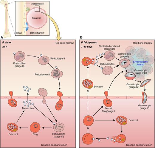 Proposed model for P vivax development in the bone marrow. (A) P vivax infects stage III reticulocytes that have egressed by diapedesis to the sinusoidal capillary lumen. Alternatively, P vivax merozoites or P vivax–infected erythrocytes might enter the red bone marrow compartment, leading to invasion of CD71+ reticulocytes. Accelerated reticulocyte aging increases host cell deformability for subsequent endothelial crossing toward blood circulation. Adapted from Figure 5 in the article by Malleret et al that begins on page 1314. (B) Proposed model for P falciparum development in the bone marrow. Presence of immature gametocytes in the bone marrow extravascular space may be explained by erythrocytes infected by stage I gametocytes or sexually committed ring stages entering the bone marrow stroma through the endothelial lining. Alternatively, asexual schizonts, which develop in the extravascular compartment, may produce sexually committed merozoites that invade erythroid precursors, whose remodeling may share possible similarities with that of P vivax. Mature gametocyte-infected host cells cross the endothelial barrier to reenter the circulation. Adapted from supplemental Figure 7 in Joice et al.7 Professional illustration by Patrick Lane, ScEYEnce Studios.