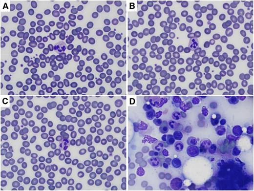 Figure 1. Wright (Diff Quik) staining of peripheral blood and bone marrow after heat and/or prolonged methanol fixation. Images were captured on an Olympus BX41 microscope using the 100× oil objective, and an Olympus DP72 camera with Olympus CellSens Entry software. (A) Peripheral blood smear heated for 60 minutes at 95°C before staining. (B) Peripheral blood smear fixed in methanol for 30 minutes before staining. (C) Peripheral blood smear heated for 60 minutes at 95°C and then fixed in methanol for 30 minutes before staining. (D) Bone marrow aspirate heated for 60 minutes at 95°C and then fixed in methanol for 30 minutes before staining. Normal erythrocyte morphology and leukocyte details are seen in peripheral blood smears regardless of treatment, and cellular details are preserved in bone marrow aspirate.