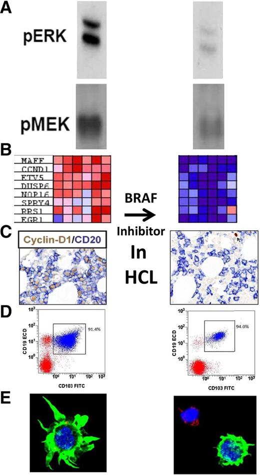 Studies performed by Pettirossi et al to confirm the mechanism of BRAF inhibition in HCL. (Left) Before and (right) after BRAF inhibition with vemurafenib. From top to bottom: (A) phosphorylated ERK and MEK; (B) HCL-related genes with large differences in expression before and after vemurafenib (each column, 1 of 6 patients); (C) bone marrow immunohistochemistry for cyclin D1 and CD20; (D) flow cytometry of the bone marrow aspirate; and (E) confocal microscopy of HCL cells showing loss of hairy morphology. See Figures 1A, 2B, 3A,C, and 4C-D in the article by Pettirossi et al that begins on page 1207.