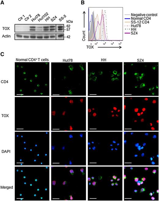 Figure 2. TOX protein levels are increased in SS CD4+ T cells and in CTCL cell lines. (A) Western blot analysis showed TOX overexpression in 4 CTCL cell lines (Hut78, Hut102, HH, and SZ4) and in CD4+ T cells from the peripheral blood of a patient with SS (SS-5), compared to peripheral CD4+ T cells from an HP (Ctr 1) or a patient with BID (Ctr 2). For each sample, cell lysate was extracted as described in the “Methods and materials” section and probed with antibodies specific for TOX and actin proteins. (B) FACS analysis showed TOX elevation in the peripheral CD4+ T cells from a patient with SS (SS-12) and in the CTCL cell lines Hut78, HH, and SZ4, whereas normal CD4+ T cells were negative for TOX staining. A fluorescence-minus-one control was included as a negative control. (C) Immunofluorescence staining showed strong nuclear TOX staining in the CTCL cells lines Hut78, HH, and SZ4 but not in normal CD4+ T cells. For each cell type, 1 million cells were mounted onto the slide and subjected to staining as described in the “Methods and materials” section. Bars represent 25 μm. DAPI, 4′,6 diamidino-2-phenylindole.