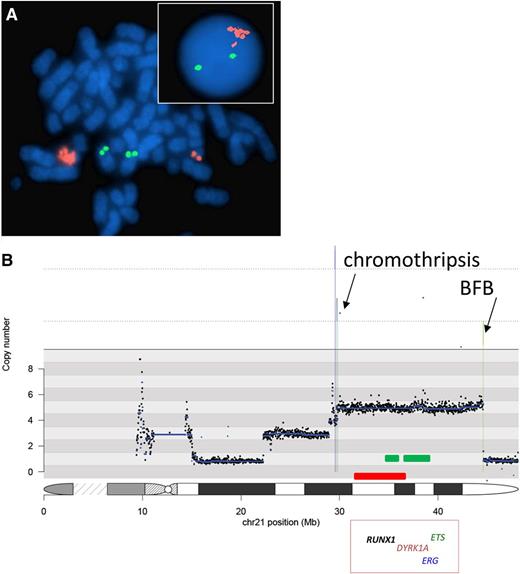 Figure 1. Examples of FISH and next-generation sequencing iAMP21 data. (A) Cells from a patient with iAMP21. The red signals indicate copies of RUNX1, and the green signals indicate copies of ETV6 using FISH with a dual-color probe for the detection of the ETV6-RUNX1 fusion. No fusions are present in these cells. In the metaphase, the 2 pairs of green signals indicate the normal location of ETV6 on the short arm of the 2 normal chromosome 12 homologs. The individual pair of red signals on the right-hand side of the cell shows the location of RUNX1 on the normal chromosome 21. On the left-hand side of the cell, the cluster of red signals indicates amplification of RUNX1 on the abnormal chromosome 21 (iAMP21 chromosome). In the interphase cell (inset), the 2 green signals indicate the presence of 2 copies of ETV6. The cluster of red signals indicates the amplification of RUNX1. The fact that these signals are clustered implies that they are located in close proximity on a single chromosome. These characteristics define iAMP21. (B) A typical sporadic-iAMP21 copy-number profile of the chromosome 21 derived from paired-end sequencing data.21 Fluctuations above and below a copy number of 2 indicate gain and deletion, respectively. The profile covers the whole of chromosome 21, from centromere (left had side) to telomere (right hand side), and the chromosome positions are indicated in Mb. The deletion of the telomeric region indicates the breakpoint from which the BFB cycle was initiated in this patient. The stepwise changes in copy number along chromosome 21 represent the typical profile generated from BFB cycles, with the most highly amplified region juxtaposed to the deleted telomeric region. There are a small number of rearrangements resulting from chromothripsis in this patient. The originally defined common region of amplification of 5.1 Mb is indicated by the red bar, and the consistently most highly amplified and overexpressed regions generated from a consensus copy-number profile21 are indicated by the green bars. These regions include genes important in hematologic malignancies, and some examples with their relative locations are shown in the red box.