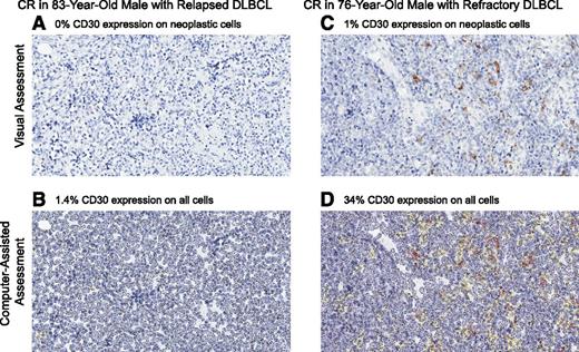 Figure 3. CD30 expression per IHC assessed by visual and computer-assisted methods. An 83-year-old male with relapsed DLBCL achieved a CR after 2 cycles of treatment and had (A) 0% CD30 expression by visual central review and (B) 1.4% CD30 expression by computer-assisted methods. He discontinued treatment after 7 cycles of therapy as a result of grade 2 PSN and subsequently progressed (response duration ∼4 months). A 76-year-old male with refractory DLBCL achieved a CR after 2 cycles of treatment and had (C) 1% CD30 expression by visual central review and (D) 34% CD30 expression by computer-assisted methods. He discontinued treatment after 17 cycles of therapy as a result of PD (response duration ∼11 months).