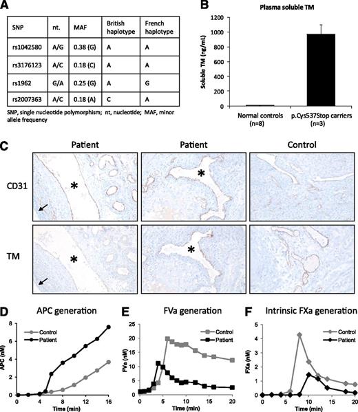 Figure 2. Functional consequences of the THBD c.1611C>A (p.Cys537Stop) mutation. (A) THBD haplotype analysis. Four haplotype-tagging SNPs (MAF ≥ 0.05, r2 threshold 0.8) capturing most of the common genetic variation in the THBD gene in the Caucasian population were identified using the Genome Variation Server of SeattleSNPs (http://gvs.gs.washington.edu/GVS138/). All available members of the British (n = 3) and French (n = 9) families with the c.1611C>A mutation were genotyped for these SNPs and the haplotype underlying the mutation in each family was reconstructed by allele segregation analysis. (B) Plasma concentrations of soluble TM in normal controls (n = 8) and in carriers of the p.Cys537Stop mutation (n = 3, proband and 2 family members). (C) Expression of membrane-bound TM in ovarian tissue. Histological sections of the patient’s ovarian tissue (left and middle panels) prepared at the time of her ovariectomy (1995) were stained for the endothelial marker CD31 and for TM, as indicated. Archival ovarian tissue obtained from a woman undergoing surgical resection at the same time as the patient, processed in the same way and stored in the same room for a comparable time, served as a normal control (right panels). (Left panels) A large venous vessel (*), associated with numerous smaller arterial and venous vessels, is visible in the ovarian stroma near a follicular ovarian cyst (arrow). CD31 is readily discernible along the endothelial lining of all visible vessels, whereas TM is barely detectable. (Middle panels) A large vessel (*) in the ovarian stroma is cross-sectioned. Although CD31 is detectable all along the endothelial lining, TM shows heterogeneous expression and is not detectable in the smaller adjacent vessels. (Right panels) CD31 and TM show strong and comparable apparent expression levels and their distribution is homogeneous along the endothelial linings. Immunoperoxidase technique followed by nuclear counterstaining with Mayer’s hematoxylin. Original magnifications: left and middle panels, ×250; right panels, ×350. (D) APC generation. Control plasma (gray circles) and the patient’s plasma (black circles) were activated with 1 pM TF, 4 μM phospholipids, and 16.6 mM CaCl2. At timed intervals, aliquots were removed and assayed for APC as described in “Materials and methods”. (E) FVa generation. Control plasma (gray circles) and the patient’s plasma (black circles) were activated with 1 pM TF, 4 μM phospholipids, and 16.6 mM CaCl2. At timed intervals, aliquots were removed and assayed for FVa as described in “Materials and methods”. Addition of a neutralizing anti-protein C antibody (not shown) abolished the difference in FVa generation between the patient’s and control plasma. (F) Intrinsic FXa generation. Control plasma (gray diamonds) and patient’s plasma (black diamonds) were activated with 2 nM FIXa, 4 μM phospholipids, and 16.6 mM CaCl2. At timed intervals, aliquots were removed and assayed for FXa as described in “Materials and methods”. Because the experiment was conducted at limiting FVIIIa concentrations, the generated FXa is proportional to the FVIIIa concentration.