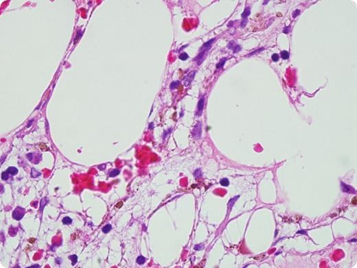 A 27-year-old woman with end-stage renal disease due to type 1 diabetes underwent simultaneous pancreas-kidney (SPK) transplantation with a 2A, 2B, 1DR HLA-mismatched, male-to-female graft. Conditioning included antithymocyte globulin (7 mg/kg over 4 days) and methylprednisolone (500 mg intraoperatively). Tacrolimus, azathioprine, and standard tapering doses of steroids were used for posttransplant immunosuppression. Four weeks posttransplant, the patient developed progressive pancytopenia (white blood cell count, 0.1 × 109/L; hemoglobin, 6.6 g/dL; platelets, 23 × 109/L) with an unremarkable extensive workup. The bone marrow was aplastic. Interphase fluorescence in situ hybridization for sex chromosome DNA demonstrated 57% donor cells in the marrow. Short tandem repeat CD3+-enriched identity testing on the peripheral blood revealed 81% donor T cells. A diagnosis of isolated bone marrow aplasia due to acute graft-versus-host disease (aGVHD) was established. Treatment with high-dose steroids and antithymocyte globulin was unsuccessful. During reduced-intensity conditioning for salvage stem cell transplantation, the patient succumbed to invasive aspergillosis. / Only a handful of cases of aGVHD following SPK transplantation have been reported. Immunocompetent passenger T cells in the graft attack HLA-disparate epithelial tissues in the immunocompromised host. Bone marrow aplasia, often considered a terminal event, is the consequence of destruction of hematopoietic progenitor/stem cells or their supporting niche by alloreactive T cells, and can precede, concur with, or follow other organ (skin, gut, and liver) involvement.
