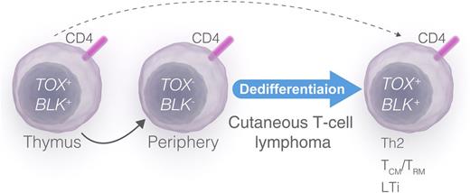 A proposed model of malignant dedifferentiation and TOX expression in CTCL. TOX and BLK become upregulated during thymic development of CD4+ T cells (left). In contrast, mature peripheral CD4+ T cells do not upregulate TOX on TCR stimulation and do not express BLK (middle). TOX- and BLK-positive malignant T-cell clones arise from a derailed thymic stem cell (dashed arrow) or as a result of TOX-dependent and/or TOX-independent dedifferentiation of malignant T cells or a precursor T cell (solid arrow). Dedifferentiation of the malignant T cell (or a precursor T cell) drives deregulated expression of transcription factors (including TOX), Scr kinases (including BLK), cytokines, and lymphangiogenic factor (right), leading to progressive disease and a mixed phenotype mimicking Th2, Th17, Th22, central memory/resident memory T cells (TCM/TRM), and LTi cells (right). Professional illustration by Luk Cox, Somersault 18:24.