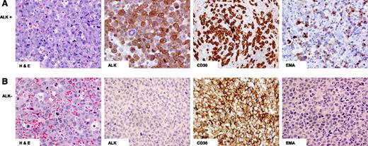 Figure 1. Hematoxylin and eosin (H&E) and immunohistochemical staining of ALCL. (A) ALK+: Hallmark cells demonstrated by H&E staining and tumor cells positive for ALK, CD30, and epithelial membrane antigen (EMA); (B) ALK−: Hallmark cells demonstrated by H&E staining and tumor cells positive for CD30 but negative for ALK and EMA staining.