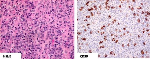 Figure 2. CD30+ PTCL-NOS. H&E staining demonstrates predominantly small- to medium-size lymphocytes with pleomorphism and the absence of hallmark cells. Only scattered tumor cells demonstrate CD30 positivity compared with ALCL.