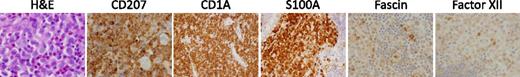 Figure 1. Histology of LCH lesions. This figure depicts a typical LCH lesion with characteristic histology. Pathologic “histiocytes” with reniform nuclei and eosinophilic cytoplasm are scattered among an infiltrate of lymphocytes, eosinophils, and macrophages. The LCH cells react to immunostains for CD207, CD1a, and S100, but not for fascin or factor XIIIa. This biopsy could be from any child or adult with low- or high-risk LCH. H&E, hematoxylin and eosin. Images courtesy of John Hicks, Baylor College of Medicine.