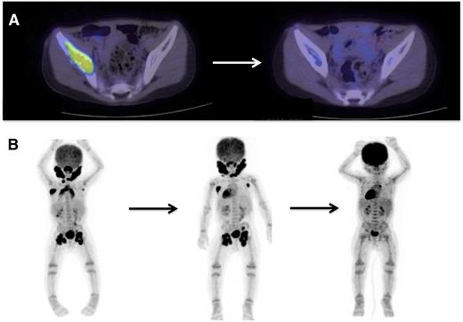 Figure 4. PET/CT scans are effective to stage disease and to evaluate response to therapy in LCH. Examples of 18-fluoro-deoxyglucose–PET scans with CT identifying response to therapy. (A) A patient with multifocal bone disease with interval improvement of pelvic lesion and decreased PET avidity. (B) A patient with multifocal lymph node disease (cervical, axillary, inguinal) who initially failed to respond to cytarabine therapy, then had significant response to 2 cycles of clofarabine.