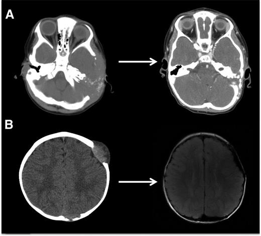 Figure 5. LCH bone lesions may remodel if margins remain intact. These cases highlight the potential for even very large bone lesions to remodel following disease resolution. (A) Skull CT scans before and after chemotherapy in a patient with multifocal bone LCH. Remodeling following systemic chemotherapy nearly normalizes bone structure in a patient with significant skull lesions. This patient did not have any curettage or excisional surgery in the skull. (B) Brain MRI in a patient with multifocal bone LCH before and after complete excision with placement of mesh grafts. Complete excision of LCH lesion with margins into healthy bone inhibits potential for remodeling. Following resections and successful chemotherapy, skull defects persist.