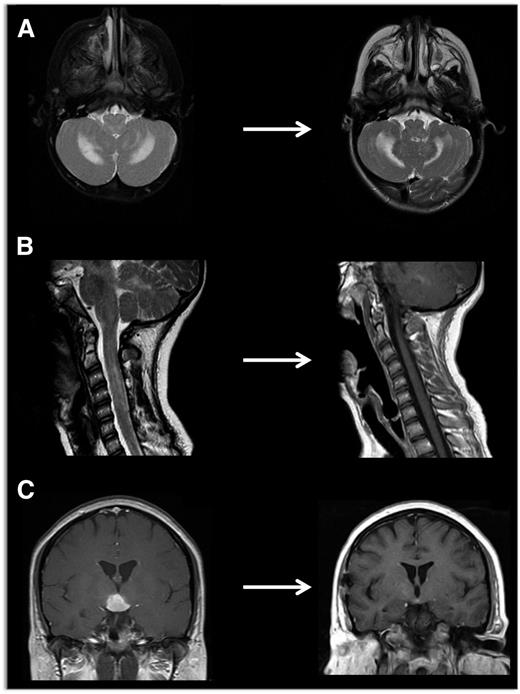 Figure 6. Neuroimaging of LCH lesions. These examples demonstrate typical manifestations of LCH CNS and spinal cord lesions. (A) Brain MRI demonstrates T2-hyperintensity in cerebellum classic for LCH neurodegenerative syndrome. In this case, the patient had radiologic and clinical response to treatment with cytarabine. (B) Spinal MRI demonstrates significant spinal cord lesions. This is a somewhat atypical case of a 13-year-old girl who had marginal response to cytarabine, then clofarabine. BRAF-V600E was detected in cells from the CSF, and the patient ultimately had radiologic and clinical response to vemurafenib. (C) Brain MRI demonstrates a pituitary mass classic for LCH, though differential diagnosis also includes germinoma, lymphoma, and pituitary hypophysitis. In this case, the lesion was biopsy proven to be LCH, and the patient responded to cytarabine therapy.
