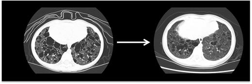 Figure 7. Pulmonary LCH. This high-resolution CT scan demonstrates pulmonary lesions and associated cysts in a 3-year-old girl with high-risk LCH. LCH lesions were cleared from lung parenchyma following cladribine therapy, though some cystic disease was irreversible.