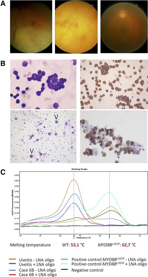 Figure 1. Clinical, cytologic, immunohistochemical, and molecular findings in VRL. (A) Representative fundus photographs of 3 VRL patients: VRL with retinal and choroidal infiltration (left), with massive infiltration at rear pole (middle) and with vitreous infiltration only (right). (B) Upper left: PVRL, 49-year-old woman, MYD88L265P. Highly cellular vitreous body aspirate with numerous atypical lymphocytes (May-Grünwald-Giemsa staining, left). Virtually all cells stain for CD20 (immunoperoxidase, right). Lower left: PVRL, 63-year-old woman, MYD88L265P. The aspirate shows rare atypical cells with basophilic cytoplasm (arrowheads, May-Grünwald-Giemsa staining). Clonality analysis was noncontributory and the case was considered as nondiagnostic for PVRL. Lower right: PVRL, 70-year-old woman. MYD88L265P, monoclonal IGH rearrangement. CD20 stain. All images taken at original magnification ×400. (C) Representative example of MYD88 codon 265 locked nucleic acid (LNA)-clamped, allele-specific PCR and melting curve analysis. One case with final diagnosis uveitis shows the WT curve with the melting peak at 62.7°C, whereas case 6B, which initially was considered reactive, turned out to be MYD88L265P-mutated, melting at 53.1°C.