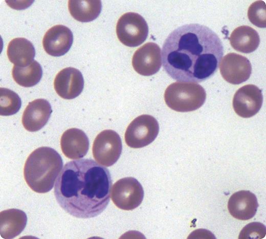 A 37-year-old woman initially presented with pancytopenia and found to have leukopenia (2.1 × 103/μL) with 13% atypical promyelocytes, anemia (hemoglobin of 6.8 g/dL), and thrombocytopenia (41 000 per μL). The atypical promyelocytes were medium to large in size with frequent bilobed nuclei, fine chromatin, and abundant cytoplasmic granules with occasional Auer rods. She was diagnosed with acute promyelocytic leukemia (APL) following a bone marrow (BM) biopsy. Molecular studies confirmed the unique (15;17) chromosomal translocation. She was admitted and started on all-trans retinoic acid (ATRA) therapy. On day 16 of her hospitalization and treatment, her peripheral blood smear showed hypogranular neutrophils with decreased secondary granules and cytoplasmic inclusions consistent with Auer rods. / ATRA is used as a therapeutic agent in patients with APL to induce the differentiation of leukemic cells. Neutrophils in the BM and blood of patients during ATRA treatment occasionally contain Auer rods, consistent with their derivation from leukemic cells. Although ATRA is effective in inducing differentiation of APL cells, it is incapable of inducing complete neutrophil morphologic maturation. In addition to APL, Auer rods in neutrophils are also described in acute myeloid leukemia (AML) t(8;21), AML with maturation, and mixed lineage leukemia.