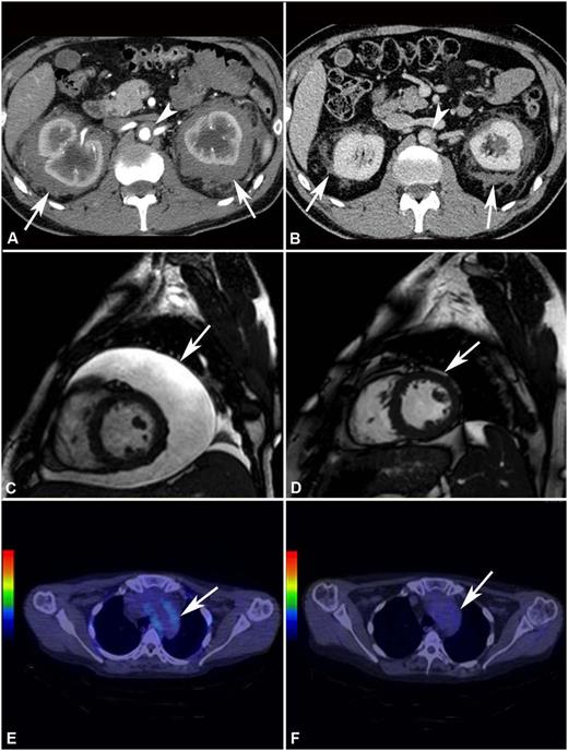 Figure 1. Response to treatment assessed by different imaging modalities. (A) Abdominal CT performed before treatment and (B) after 4 years of SRL and PDN treatment in patient #2. The scans show marked shrinkage of peri-renal (arrows) and peri-aortic fibrosis (arrowhead). (C) Cardiac MRI (T2-weighted, fat-saturation sequence, sagittal view) performed before treatment and (D) after 12 months of treatment with SRL and PDN in patient #10. The scans show neither recurrence of pericardial effusion (arrow) (the patient had also undergone pericardiocentesis) nor signs of pericardial infiltration. (E) 18F-FDG PET-CT performed before and (F) after 12 months of treatment with SRL and PDN in patient #10. The scans (axial view) show disappearance of 18F-FDG uptake at the thoracic aorta level (aortic arch) (arrow).