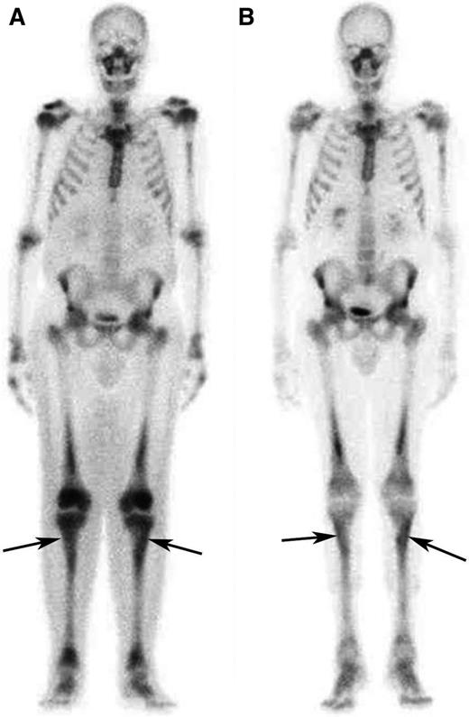 Figure 2. Response to treatment in the long bones assessed by bone scintigraphy. (A) Whole-body 99Tc-bone scintigraphy performed before treatment and (B) after 12 months of treatment with SRL and PDN in patient #5. The scans show a significant reduction in tracer uptake especially in long bones such as the tibias (arrows) and the femurs.