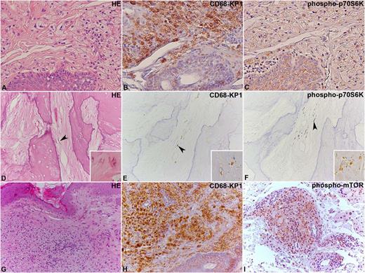 Figure 3. Immunohistochemical analysis of phospho-mTOR and phospho-p70S6K in ECD lesions. (A-C) Two ECD cases located in the skin and (D-F) bone, where the lesional CD68-KP1–positive histiocytes (B,E) show immunoreaction for phospho-p70S6K (C,F). In (D-F), the arrowhead indicates some elongated histiocytes, whose shape results from their encasement by abundant sclerotic fibrous tissue. An additional case of ECD involving the skin (G-I) with CD68-KP1–positive histiocytes (H), which also react with an anti–phospho-mTOR antibody (I) is shown. Original magnification: (A-I), ×20; insets in (D-F), ×40. HE, hematoxylin and eosin.