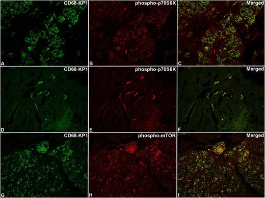 Figure 4. Confocal microscopy analysis of phospho-mTOR and phospho-p70S6K in ECD lesions. The same cases as those shown in Figure 3 with immunoreaction for CD68-KP1 (A,D,G), phospho-p70S6K (B,E), phospho-mTOR (H), and relevant merged images (C,F,I). Original magnification: (A-I), ×63.
