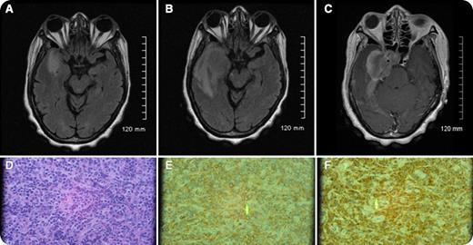 A 65-year-old woman initially presented with chronic extreme headaches. Initial magnetic resonance imaging (MRI) scans (panel A) revealed abnormal signaling possibly representing dural inflammation or a meningioma. A complete blood count at that time was within normal limits. Four weeks later, her symptoms included progressively worsening, right temporal throbbing headaches with associated right eye visual disturbance and right facial paresthesias. Repeat MRI (panels B and C) revealed enlargement of the dural mass now extending into the right cavernous sinus and right optic canal. Initial cerebrospinal fluid studies were negative for cytology and infection. A biopsy revealed a myeloid sarcoma (panels D-F). A peripheral smear revealed 10% circulating blasts, and a subsequent bone marrow biopsy revealed acute myeloid leukemia (AML) with 8:21 translocation. / In patients with AML, less than 1% present initially with prominent extramedullary disease, including myeloid sarcoma. Myeloid sarcoma may present simultaneously with bone marrow disease, precede bone marrow disease, or be seen in disease relapse. The presence of a myeloid sarcoma is diagnostic of AML independent of the blast count. Myeloid sarcoma may be found in many isolated sites, including the dura, periosteum, and bone. Myeloid sarcoma must be considered in the differential diagnosis in the presence of a rapidly progressing dural mass.