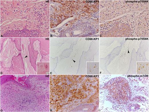 Immunohistochemical analysis of phospho-mTOR and phospho-p70S6K in ECD lesions. Two ECD cases located in the skin (A-C) and bone (D-F) where the lesional CD68-KP1–positive histiocytes (B,E) show immunoreaction for phospho-p70S6K (C,F). In panels D-F, the arrowhead indicates some elongated histiocytes, whose shape results from their encasement by abundant sclerotic fibrous tissue. An additional case of ECD involving the skin (G-I) with CD68-KP1–positive histiocytes (H) that also react with an anti–phospho- mTOR antibody (I). Original magnification: A-I, ×20; insets in D-F, ×40. HE, hematoxylin and eosin. See Figure 3 in the article by Gianfreda et al that begins on page 1163.
