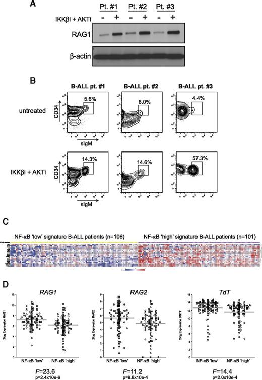 Figure 6. Inhibition of AKT and NF-κB signaling induces RAG1 protein expression in primary human B-ALL cells, and NF-κB gene expression signature negatively correlates with RAG1, RAG2, and TdT mRNA expression in untreated B-ALL patients. (A) Immunoblot analysis of whole-cell extracts from primary (BCR-ABL-negative) B-ALL blasts (n = 3) cultured for 48 hours with 2.5 μM IKKβi and 2.5 μM AKTi or vehicle (DMSO; untreated). (B) FACS plots of primary human B-ALL cells from 3 patients cultured for 48 hours with 2.5 μM IKKβi and 2.5 μM AKTi or vehicle (DMSO; untreated). FACS plots show CD34 vs surface IgM (sIgM) expression within the CD19+ gate; gated events were CD10+ (data not shown). Numbers above outlined gates indicate percentage of cells. (C) Heatmap showing NF-κB low (yellow squares) and NF-κB high (purple squares) B-ALL patient subgroups based on a 19 NF-κB pathway/target classifier gene expression profile. Each column represents a B-ALL patient, and each row represents a unique gene classifying the 2 subgroups. (D) Relative RAG1, RAG2, and TdT mRNA expression in NF-κB low and NF-κB high signature B-ALL patients. Each circle represents an individual patient, 2log expression is depicted, and gray bars indicate means. The ANOVA F-statistic and P value are given below each graph.