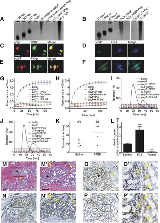 Figure 3. Prostasomes, PC cells, and PC tissue expose procoagulant polyP. Isolation of polyP from prostasomes and PC cells: (A-B) PolyP was extracted from PC3 (A) prostasomes and (B) cells by an anion exchanger chromatography, separated by electrophoresis on polyacrylamide/urea gel and visualized by DAPI-negative staining. Synthetic polyP with mean chain lengths of 134, 383, and 637 serves as molecular size standard. Purified polyP and synthetic LC polyP were loaded before and after incubation with phosphatase (Psp, 10 U/mL for 1 hour). (C,E) Epifluorescence images of polyP on PC3 prostasomes using Alexa 594-labeled PPBD. The polymer colocalizes with (C) prostasome surface membrane marker CD63 (anti-CD63) and (E) FXIIa (3F7). (D,F) Confocal laser scanning microscopy of polyP in (D) nonpermeabilized and (F) permeabilized PC3 cells. PolyP is stained with Alexa 488-conjugated PPBD, and DNA was visualized with DAPI. Bar is 500 nm in C and E and 10 µm in D and F. (G-H) PC polyP activates FXII. Platelet-free plasma was incubated with 1.5 µg/mL PC3 (G) prostasome or (H) cell polyP in the absence or presence of PPBD (1 mg/mL), generation 1.0 dendrimer (25 µg/mL), or Psp (1 U/mL). PolyP-treated FXII-deficient plasma (FXII def.) and buffer-stimulated normal plasma (buffer) is shown as control. Hydrolysis of the chromogenic substrate S-2302 measures formed FXIIa and PK. Mean ± SEM, n = 6. (I-J) Real-time thrombin formation generated in platelet-free plasma stimulated with 1.5 µg/mL (I) prostasome or (J) PC3 cell polyP in the absence or presence of PPBD (0.5 and 2 mg/mL) or generation 1.0 dendrimer (25 µg/mL). Thrombin formation in polyP-activated FXII-deficient plasma (FXII def.) and buffer-stimulated normal plasma is blotted for comparison. A representative thrombin generation curve of a series of n = 6 is shown. (K) Mortality associated with intravenous injection of PC3 prostasomes (0.8 µg/g bw) in WT mice pretreated with saline or PPBD (150 µg/g bw) was assessed in each group (n = 5); animals alive at 30 minutes after challenge were considered survivors. *P < .05 vs saline, unpaired Student t test. (L) PolyP detection on seminal, PC3 cell, and patient prostasomes using PPBD binding in an ELISA. Bars represent polyP content relative to seminal prostasomes, mean ± SEM, n = 3. ***P < .001 vs seminal prostasomes, 1-way ANOVA. (M-P′) Immunohistochemistry of FXII, polyP, and fibrin in human PC tissue sections. (M-M′) Hematoxylin/eosin-staining of the adenocarcinoma (arrows denote occluded vessels). Immunohistochemical localization of FXII using (N-N′) anti-FXII antibodies (arrows indicate FXII-positive occluded vessels and cancer tissue, respectively), (O-O′) polyP using recombinant PPBD as a probe (arrows), and (P-P′) fibrin deposits using 59D8 antibody (arrows) in (M-N′) paraffin and (O-P′) cryo sections. Black and yellow asterisks denote tissue areas containing cancer cells and nonmalignant tissue, respectively. Sections were counterstained with Mayer’s hematoxylin. Scale bars, 100 µm.