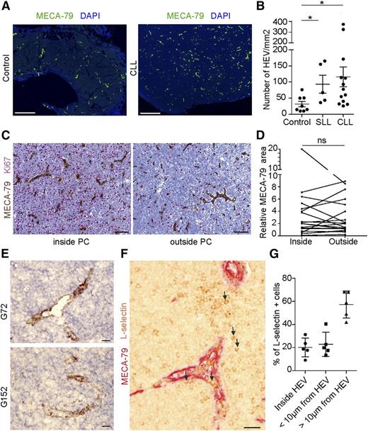 Figure 1. Analysis of the HEV network in CLL/SLL LNs. (A) Representative images showing the density and the distribution of HEV blood vessels (MECA-79+, green) in a reactive LN (control; left) and a CLL LN (CLL; right). Scale bar, 500 µm. (B) HEV density (number of HEVs/mm2) was quantified on control (n = 8), SLL (n = 5), and CLL (n = 13) LNs. Unpaired t test; *P < .05. (C) CLL LNs were double-stained with MECA-79 (brown) and Abs directed against Ki-67 (red). Scale bar, 100 µm. (D) Relative MECA-79+ area was quantified inside proliferation centers (PCs) (sum of MECA-79+ area inside all PC/sum of PC area × 100) and outside area (sum of MECA-79+ area outside all PC/overall area − sum of PC area × 100) in CLL/SLL LNs (n = 19). PCs were revealed by Ki-67 staining. Paired t test. (E) Representative image showing staining of HEV blood vessels in CLL LNs with HEV-specific Abs G72 and G152 (brown). Scale bar, 20 µm. (F) Double staining of a CLL LN section with anti-L-selectin Ab (brown) and HEV-specific Ab MECA-79 (red), showing L-selectin+ cells (arrows) inside, around, or at a distance from MECA-79+ HEVs. Scale bar, 20 µm. (G) Quantification of the percentage of L-selectin+ cells inside (inside HEV), around (<10 µm from HEV), or at a distance (>10 µm from HEV) from MECA-79+ HEVs. A total of 362 L-selectin+ cells were counted on 5 different sections from 2 different patients. DAPI, 4′,6 diamidino-2-phenylindole; ns, not significant.
