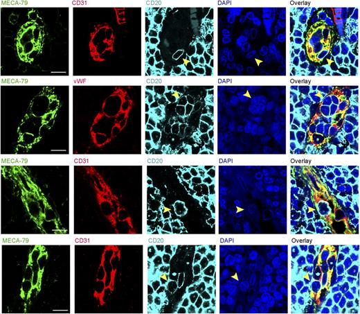 Figure 2. CD20+ CLL cells accumulate within HEV pockets in CLL LNs. Four-color confocal images showing the accumulation of CD20+ CLL cells (light blue) within HEV pockets (arrowheads) in CLL LNs. HEV endothelial cells were stained with MECA-79 (green) and CD31 or von Willebrand factor (vWF; red). Counterstaining was done with DAPI (dark blue). HEV pockets were found to house up to 4 CD20+ CLL cells. 63×, zoom 3; scale bar, 5 µm.