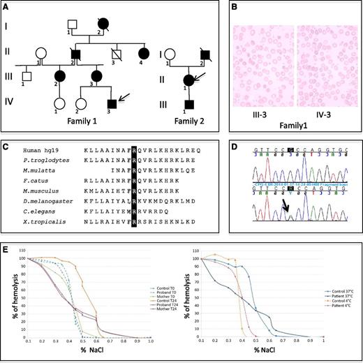 Figure 1. Red blood cell and DNA investigations. (A) Family pedigrees showing mutation segregation. (B) Blood film smears (MGG) for proband 1 and his mother. (C) Multiple interspecies protein sequence alignment of KCNN4 in the region of residue 352. (D) KCNN4 transcript sequencing: (upper) WT sequence and (lower) transcript with mutation c.1055G>A (p.Arg352His). (E) Red cell osmotic fragility test using osmotic gradient ranging from 0.1% to 1% of NaCl solution. (Left) At T0 and at T24-hour incubation at 37°C for a control and individuals III-3 and IV-3 from family 1. (Right) After T24-hour incubation at 4°C or 37°C for a control and individual III-2 from family 1.