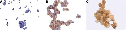 A 61-year-old woman with Waldenström macroglobulinemia (WM) was treated with 6 cycles of cyclophosphamide, rituximab, and dexamethasone between December 2011 and May 2012, and she achieved complete remission. She was given maintenance rituximab once every 3 months. Eighteen months later, the patient presented with complaints of headache and blurry vision. Physical examination revealed aphasia, paraparesis, and nuchal rigidity. A magnetic resonance imaging scan of the brain showed leptomeningeal enhancement without signs of encephalitis, stroke, or tumor. Cerebrospinal fluid (CSF) showed leukocytes 64/µL (95% mononuclear cells), glucose 9.8 mg/dL, and protein 110 mg/dL. CSF cytology and immunohistochemistry showed κ-restricted B lymphocytes. The figure shows Waldenström cells in CSF with Wright staining (panel A), CD20 expression (panel B), and kappa light chain restriction (panel C). A diagnosis of Bing-Neel syndrome (BNS) was made. The patient was treated with 6 doses of intrathecal (IT) methotrexate and hydrocortisone twice a week with reduction of neoplastic cells in the CSF. Four months later she relapsed, and an allele-specific polymerase chain reaction for MYD88L265P in CSF was positive. Intravenous fludarabine was initiated with plans to add IT liposomal cytarabine, but she refused further treatment and died at home 7 months after the diagnosis of BNS. / First reported in 1936, BNS should be suspected in patients with WM and neurologic impairment. There is no standard of care for BNS, and prospective studies are needed to address the optimal treatment of this late, rare, and dangerous complication of WM.