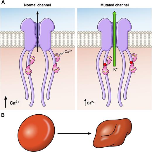 Mutated Gardos channel is activated by 10 times lower Ca2+ concentration and shows abnormally slow inactivation kinetics. These combined effects lead to excessive loss of K+ (A) and red blood cell dehydration (B), which is associated with hemolytic anemia. The disease causing the Arg352His mutation (red dot) is located in the highly conserved region of the calmodulin binding domain of the Gardos channel; calmodulin with bound Ca2+ ions is shown in pink. The other disease-causing mutations identified as Val282Met and Val282Glu are located in the predicted transmembrane loop S6 of the channel. Professional illustration by Patrick Lane, ScEYEnce Studios.