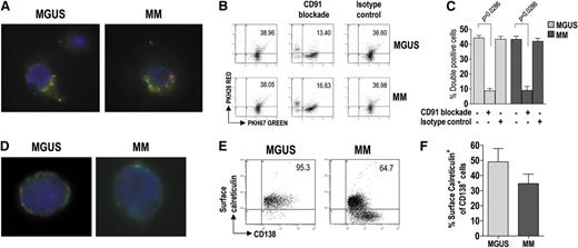 Figure 3. Uptake of apoptotic tumor plasma cells by BM DCs and role of calreticulin in this process. (A) Representative micrographs of green fluorescent, immunomagnetically purified DCs (from MGUS and MM patients) that have engulfed, in vitro, γ-irradiated red fluorescent fragments of apoptotic plasma cells. (B-C) Changes in phagocytic activity of DCs in vitro, upon treatment with a CD91-blocking mAb, determined by flow cytometry. Representative plots (B) and percentages (C) of green DCs (from 9 MGUS and 9 MM patients) containing red apoptotic plasma cell fragments. Mann-Whitney U test. (D) Representative micrographs of immunomagnetically purified plasma cells (from MGUS and MM patients) showing membrane-associated fluorescence after surface staining with FITC-conjugated mAb to calreticulin. (E-F) Representative plots (E) and percentages (F) of tumor plasma cells (from 20 MGUS and 20 MM patients) that stained positively for surface calreticulin. Mann-Whitney U test. P values are shown only for statistically significant comparisons.