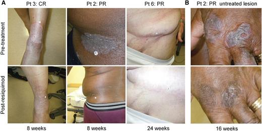 Figure 1. Topical resiquimod therapy can induce the regression of both treated and untreated skin lesions. (A) Representative clinical images are shown of treated CTCL skin lesions before and after treatment in 3 patients. Lesions are shown before therapy (top) and at the indicated times after institution of therapy. (B) Representative clinical images of an untreated CTCL lesion before therapy (top) and at 16 weeks after beginning therapy to other sites (bottom).