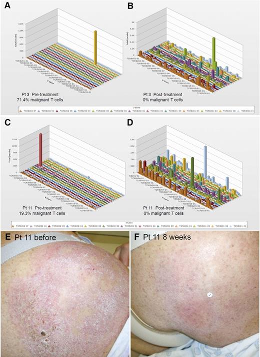 Figure 3. Evaluation of benign and malignant T cells in skin lesions before and after resiquimod therapy using HTS TCR analysis. DNA was isolated from lesional skin before and after resiquimod therapy and analyzed by HTS TCR-β analysis. HTS results before (A,C) and after (B,D) resiquimod therapy for 2 patients with a complete response are shown. This technique allows identification and quantification of the malignant T-cell clone as well as measurement of the exact number, diversity, relative proportions, and sequences of all T cells in the sample. (E,F) Clinical images of a treated lesion from patient 11 are shown. V, variable.
