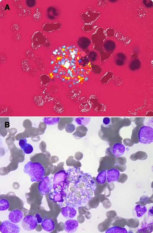 A 26-year-old man who had a kidney transplant in 2009 as a result of nephropathic cystinosis was examined for bicytopenia (platelet count, 98 × 109/L; hemoglobin, 113 g/L). May-Grünwald-Giemsa staining showed a normocellular bone marrow with numerous megakaryocytes without dysplastic features. Macrophages were profuse, and they contained abundant light gray hexagonal crystals of different sizes (panel B). These crystals appeared birefringent under polarized light (panel A), consistent with the diagnosis of cystinosis. / Cystinosis is a rare autosomal lysosomal storage disorder caused by a defect in cystine transport. This poorly soluble amino acid accumulates in the lysosomes of various organs, especially kidneys, inducing progressive kidney failure. Patients often suffer cytopenia associated with cystine crystals in the bone marrow, decreased renal production of erythropoietin, hypersplenism (splenomegaly and portal hypertension due to nodular hyperplasia), and myelofibrosis. In the case described here, anemia and thrombocytopenia remained moderate. There was no evidence of bone marrow fibrosis or palpable spleen.