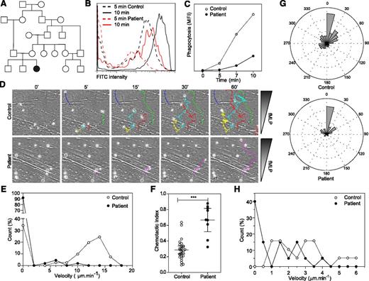 Figure 1. Patient neutrophils display phagocytosis and migration defects. (A) Family tree. (B-C) Fluorescein isothiocyanate (FITC) –positive Escherichia coli uptake by neutrophils analyzed by flow cytometry. Representative data from 2 independent experiments. (D) Migration of control and patient neutrophils in a Dunn chamber in response to an fMLP gradient. Tracks show migration path over time. The number of cells analyzed was 41 in the control and 110 and patient sample in 1 experiment. Scale bar = 10 μm. (E) Frequency distribution of the velocity of patient and control neutrophils. (F) Chemotactic index of the migrating neutrophils. (G) Distribution of instantaneous angle between the gradient and the cell path during migration. (H) Frequency distribution of the velocity of control and patient B lymphoblastoid cell lines migrating in collagen gel. Twenty cells were analyzed in each population in 1 experiment. Data are representative of 2 independent experiments. *** P < .001. MFI, mean fluorescent intensity.