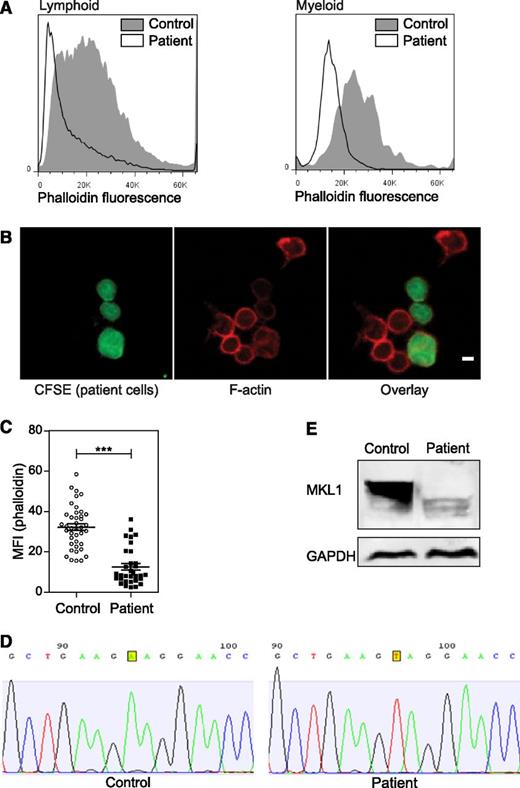 Figure 2. Effect of MKL1 mutation on F-actin. (A) F-actin (Alexa Fluor 647 phalloidin) content in lymphoid and myeloid cells was analyzed by flow cytometry. Patient cells were stained with carboxyfluorescein diacetate succinimidyl ester (CFSE) and mixed with unstained control cells before fixation and staining. Representative data from 2 experiments. (B) Confocal images of patient cells (CFSE, green), F-actin (Alexa Fluor 647 phalloidin, red), and mixed with control cells (unstained). Scale bar = 5 μm. Data were analyzed from 1 experiment. (C) Quantification of the phalloidin MFI observed in (B). (D) Sequence analysis of control and patient samples leading to the identification of the MKL1 mutation. (E) MKL1 expression visualized by western blot in control and patient peripheral blood mononuclear cells (PBMCs). ***P < .001. GAPDH, glyceraldehyde-3-phosphate dehydrogenase.