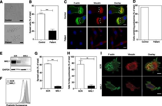 Figure 4. Patient PBMC-derived DCs have morphologic abnormalities and severely reduced F-actin content. DCs were left to adhere to fibronectin-coated glass coverslips for 4 hours and were then fixed in 4% paraformaldehyde. (A) Phase contrast imaging shows poor spreading of patient DCs compared with controls. Scale bar = 20 μm. (B) Quantification of the percent of cells that had spread. (C-D) Cells were stained for DNA (4,6 diamidino-2-phenylindole, blue), F-actin (Alexa Fluor 488 phalloidin, green), and vinculin (red), and images were acquired by confocal microscopy. Podosome structures were clearly present in control cells (F-actin cores surrounded by vinculin in 22 of 29 cells; white arrows) but completely absent in patient cells (0 of 121 cells). Data were acquired in a single experiment. Scale bar = 10 μm. (E) Western blot of MKL1 in THP1 cells expressing SCR (THP1 SCR) and against MKL1 (THP1 MKL1). (F) F-actin content in THP1 SCR and THP1 MKL1 DCs analyzed by flow cytometry. (G) Quantification of the spreading of THP1 SCR and THP1 MKL1 DCs. (H-I) Confocal images of F-actin- and vinculin-stained cells demonstrate the lack of podosomes in THP1 MKL1 DCs. Scale bar = 10 μm. THP1 MKL1 DC data were acquired in 3 independent experiments. **P < 0.01; ***P < .001.