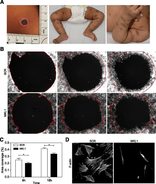 Figure 5. Knockdown of MKL1 alters fibroblast morphology and migration. (A) Clinical photos showing skin scarring and hyperpigmentation after treating skin abscesses with antibiotics. (B) Migration of fibroblasts expressing SCR and MKL1 shRNA at 0, 9, and 18 hours. (C) Quantification of the area of migration observed in (B). (D) Confocal images of fibroblasts expressing SCR and MKL1 shRNA. Cells were stained with Alexa Fluor 647 phalloidin. White arrows indicate stress fibers. *P < .05.