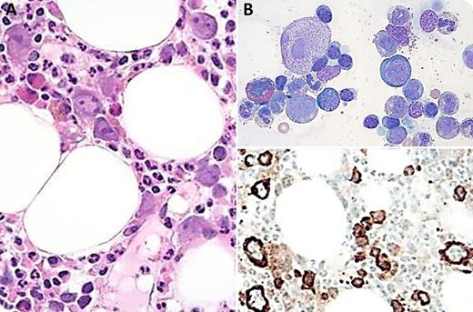A 45-year-old woman with a history of renal transplant and immunosuppressive therapy presented with worsening anemia (hemoglobin, 6.1 g/dL). The bone marrow (BM) demonstrated normocellularity (50%) and erythroid hypoplasia with lack of erythroid maturation. Several giant erythroblasts with prominent intranuclear viral inclusions and varying degrees of nuclear membrane dissolution were identified in the biopsy (panel A). CD71 immunohistochemistry confirmed the erythroblasts with viral inclusions and reduced erythroid precursors (panel C). A single giant proerythroblast with dissolving nuclear membrane was found in the BM aspirate smear (panel B). Parvovirus B19 immunoglobulin M antibody was positive (5.76; positive index >1.10) by enzyme immunoassay, and qualitative polymerase chain reaction detected DNA for parvovirus. She began receiving intravenous immunoglobulin and had a diagnosis of acute parvovirus B19 infection. / Parvovirus B19 is a single-stranded DNA virus and selectively replicates in erythroid precursors in BM or peripheral blood causing transient or permanent suppression of erythropoiesis in immunocompromised patients. These patients will develop chronic anemia, pure red cell aplasia or, less often, neutropenia and thrombocytopenia. Although the classic BM findings have been described, they can easily be overlooked because of very rare giant erythroblasts with viral inclusions or lack of suspicion of parvovirus B19 infection, leading to delayed therapy.