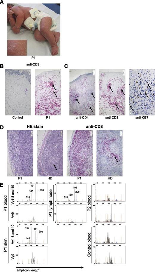 Figure 1. Features of Omenn syndrome in an immunodeficient patient. (A) Desquamative erythroderma in P1 at the age of 9 months. (B-C) Immunohistologic staining of skin biopsies. (B) Anti-CD3 staining in a healthy control and P1. Arrows indicate clusters of infiltrating T cells. Morphometric quantification of 10 high-power fields revealed that CD3 staining covered 17% of the area in the patient compared with 1% in the healthy control. (C) Staining for CD4 and CD8. Ki67 staining reflects high proliferative activity in situ (right). (D) Hematoxylin and eosin (HE) stain (left) and anti-CD8 stain (right) of a lymph node biopsy of P1 and a healthy control. Arrows indicate a normal germinal center in the control (lacking in the patient) and the T-cell zone in the control (diffusely enlarged in the patient). (E) TCRγ rearrangement analysis of samples from blood, skin, and lymph node from P1 and blood of P2 and of a healthy control using primers for Vγ1-8 (upper row, blue), Vγ10 (upper row, black), and Vγ9 (lower row, black). Amplicon length (in bp) is plotted against the fluorescence intensity (arbitrary units). Size standards are indicated in orange.